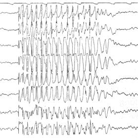 EEG während Absence