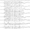 EEG during an absence